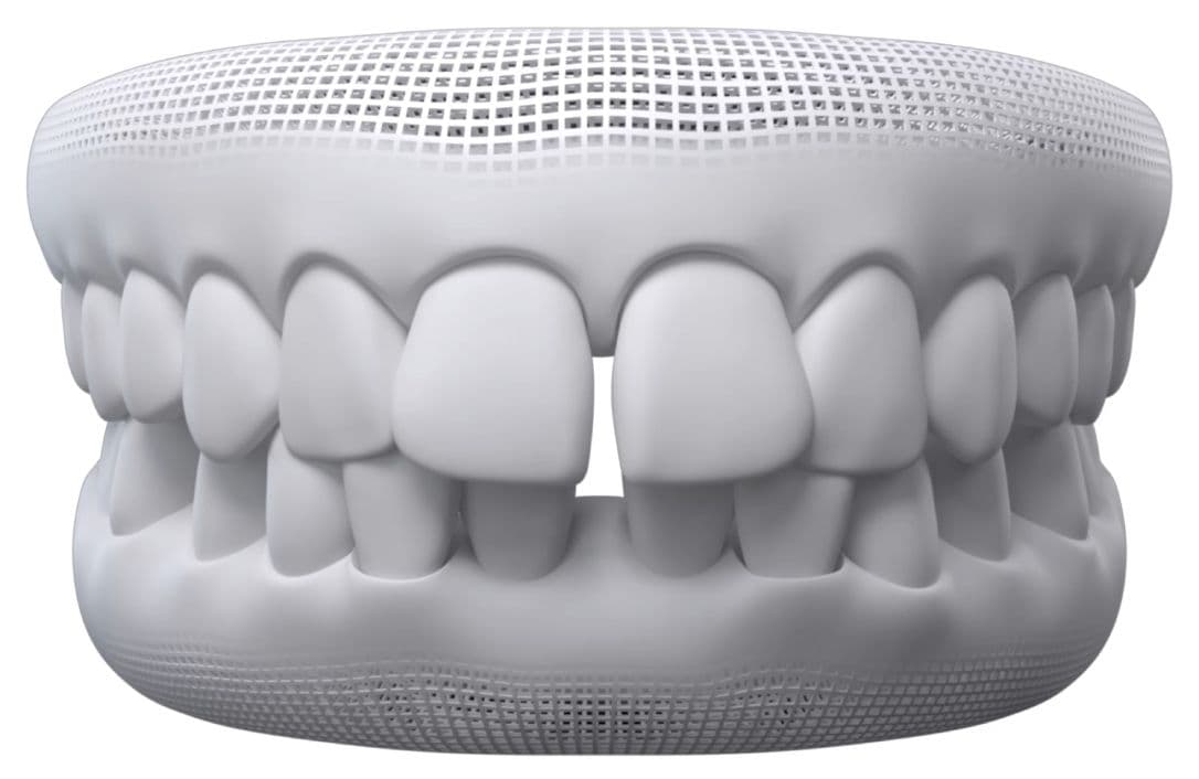 Arcada dentária ilustrando o caso de diastema