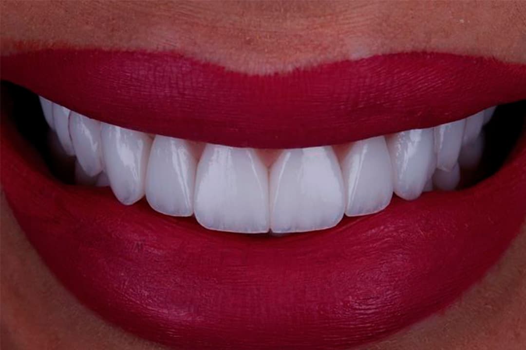 Close de um sorriso alinhado após o tratamento